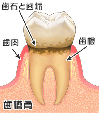 歯垢と歯石