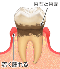 歯周病と歯石